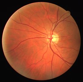 The algorithm developed by Akilan extracts data from a fundus image of the retinal vessels of the eye and classifies abnormalities that can help diagnose Alzheimer's disease.